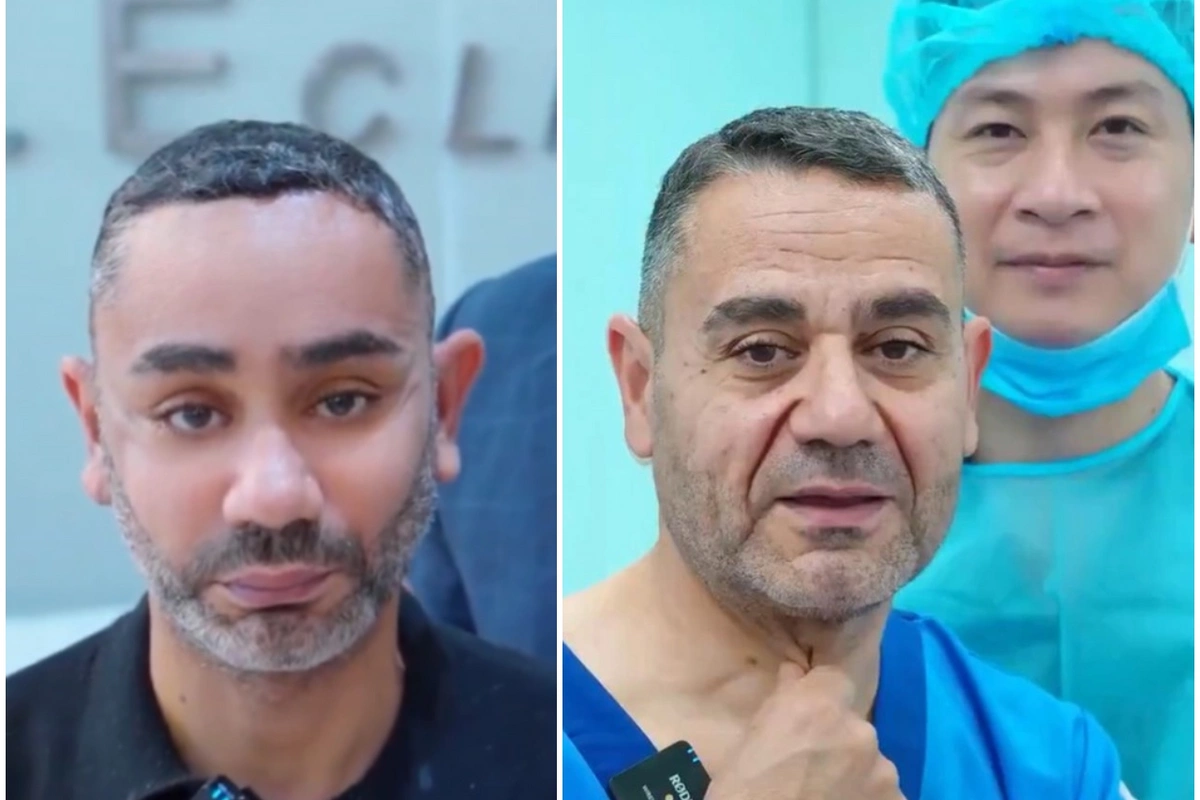 58 yaşlı kişi gəncləşmək üçün Viyetnama getdi, tanınmaz hala düşdü 58 yaşlı kişi gəncləşmək üçün Viyetnama getdi, tanınmaz hala düşdü