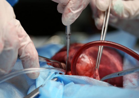 Ağciyər və qaraciyərin transplantasiyası metodu ilə müalicə zərurətinin təcililik statusuna dair meyarlar açıqlanıb