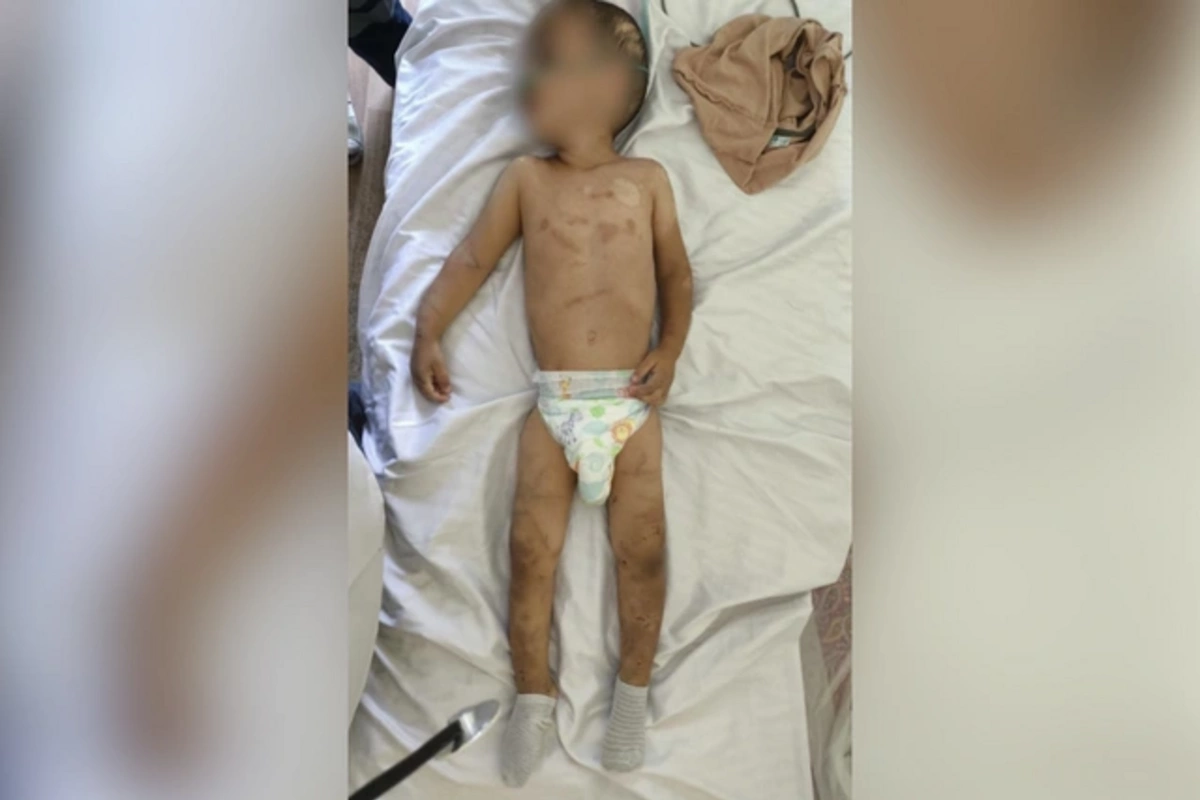 Ağdamda işgəncəyə məruz qalan körpələrin son durumu: Biri Neyrocərrahiyyə Xəstəxanasına aparılıb